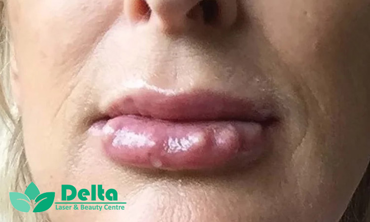 عوارض نادر تزریق ژل لب و راه های مقابله با آنها