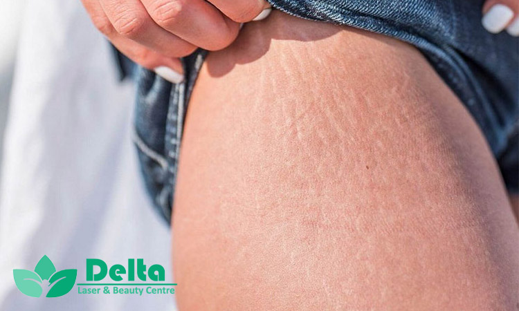 تاثیر رطوبت‌ رسان ‌ها در درمان ترک پوست خشک