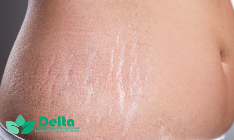 تاثیر رطوبت‌ رسان ‌ها در درمان ترک پوست خشک