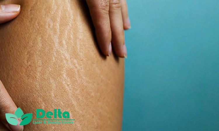 تاثیر رطوبت‌ رسان ‌ها در درمان ترک پوست خشک