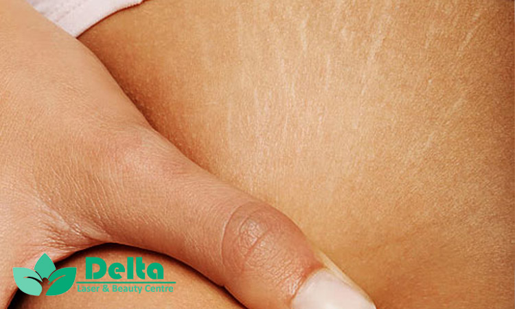 تاثیر رطوبت‌ رسان ‌ها در درمان ترک پوست خشک