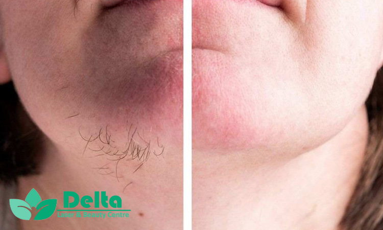 تاثیر تغذیه بر نتیجه لیزر موهای زائد